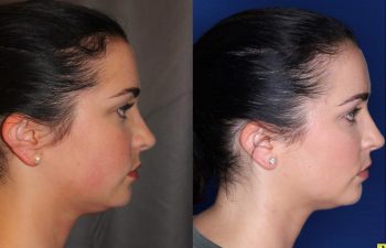 27 year old female four months after two Kybella treatments