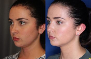 27 year old female four months after two Kybella treatments