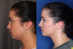 27 year old female four months after two Kybella treatments