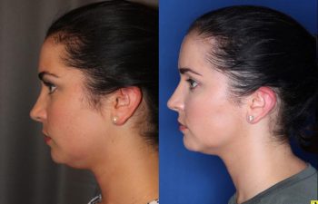 27 year old female four months after two Kybella treatments