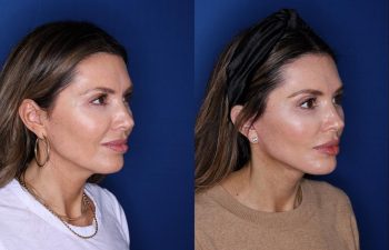 46 year old female 2 months post op from a Kaloslift extended deep plane facelift