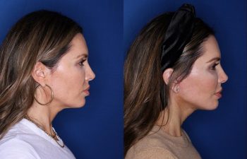 46 year old female 2 months post op from a Kaloslift extended deep plane facelift
