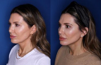 46 year old female 2 months post op from a Kaloslift extended deep plane facelift