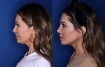 46 year old female 2 months post op from a Kaloslift extended deep plane facelift