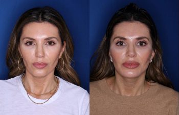 46 year old female 2 months post op from a Kaloslift extended deep plane facelift