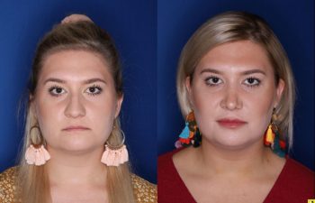 Patient Before and After Rhinoplasty