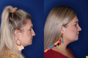 Patient Before and After Rhinoplasty