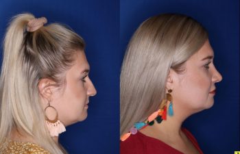 Patient Before and After Rhinoplasty