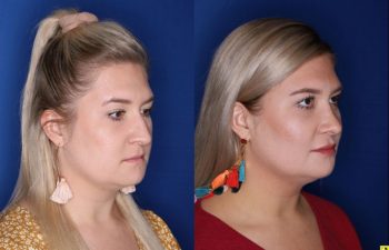 Patient Before and After Rhinoplasty