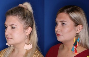 Patient Before and After Rhinoplasty
