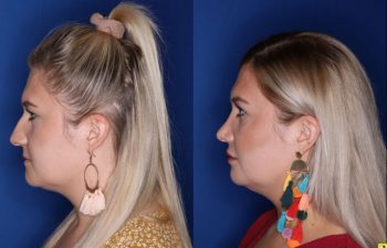 Patient Before and After Rhinoplasty