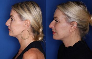 57 year old female 3 months post op from a revision lower blepharoplasty and revision facelift, kaloslift