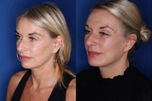 57 year old female 3 months post op from a revision lower blepharoplasty and revision facelift, kaloslift