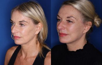 57 year old female 3 months post op from a revision lower blepharoplasty and revision facelift, kaloslift