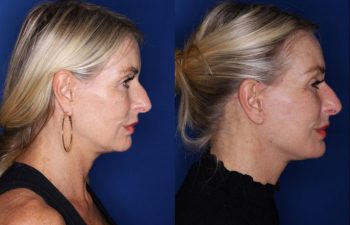 57 year old female 3 months post op from a revision lower blepharoplasty and revision facelift, kaloslift