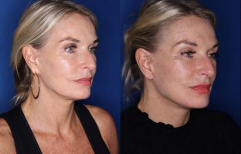 57 year old female 3 months post op from a revision lower blepharoplasty and revision facelift, kaloslift
