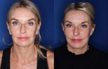 57 year old female 3 months post op from a revision lower blepharoplasty and revision facelift, kaloslift