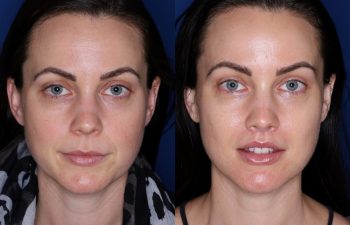 33 year old female 10 months post op from a subnasal lip lift.