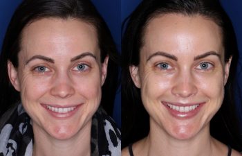 33 year old female 10 months post op from a subnasal lip lift.