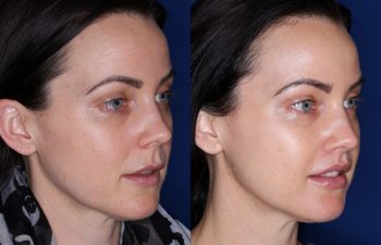 33 year old female 10 months post op from a subnasal lip lift.