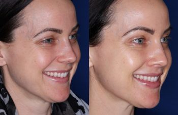 33 year old female 10 months post op from a subnasal lip lift.