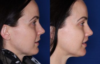 33 year old female 10 months post op from a subnasal lip lift.