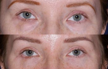 Blepharoplasty before and after photo