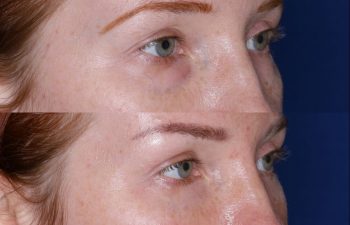 Blepharoplasty before and after photo