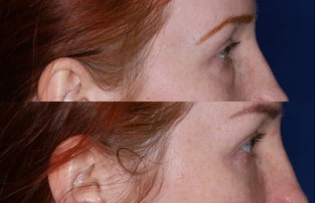 Blepharoplasty before and after photo