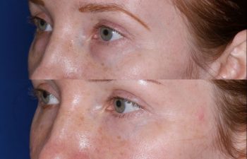 Blepharoplasty before and after photo