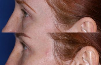 Blepharoplasty before and after photo