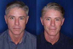 57 year old male 8 months postop from his Kaloslift Extended Deep Plane Facelift