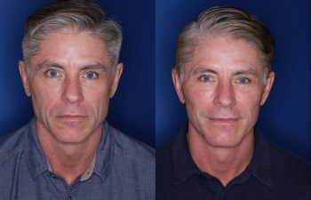 57 year old male 8 months postop from his Kaloslift Extended Deep Plane Facelift