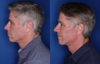 57 year old male 8 months postop from his Kaloslift Extended Deep Plane Facelift
