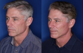 57 year old male 8 months postop from his Kaloslift Extended Deep Plane Facelift