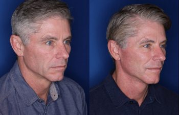 57 year old male 8 months postop from his Kaloslift Extended Deep Plane Facelift