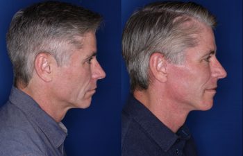 57 year old male 8 months postop from his Kaloslift Extended Deep Plane Facelift