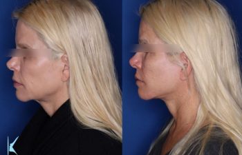 57 year old female 6 months post op from a kaloslift extended deep plane facelift