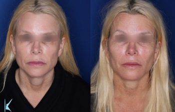 57 year old female 6 months post op from a kaloslift extended deep plane facelift