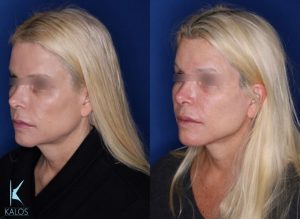 57 year old female 6 months post op from a kaloslift extended deep plane facelift