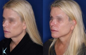 57 year old female 6 months post op from a kaloslift extended deep plane facelift