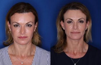 49 year old female 15 months post op from a Kaloslift, extended deep plane facelift and upper eyelid blepharoplasty