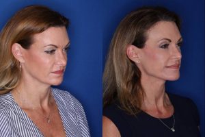 49 year old female 15 months post op from a Kaloslift, extended deep plane facelift and upper eyelid blepharoplasty
