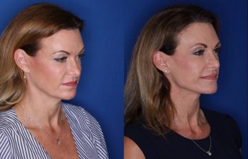 49 year old female 15 months post op from a Kaloslift, extended deep plane facelift and upper eyelid blepharoplasty