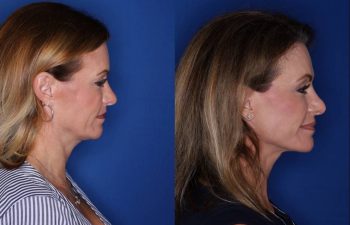 49 year old female 15 months post op from a Kaloslift, extended deep plane facelift and upper eyelid blepharoplasty
