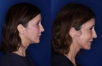 53 year old seven months post op from a Kaloslift, extended deep plane facelift