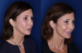 53 year old seven months post op from a Kaloslift, extended deep plane facelift
