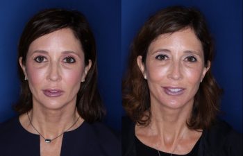 53 year old seven months post op from a Kaloslift, extended deep plane facelift