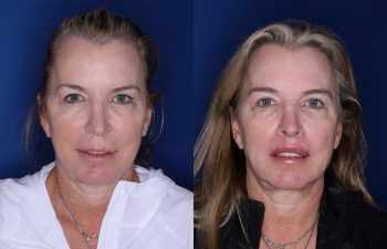 53 year old female 5 months post op from a modified subnasal lip lift