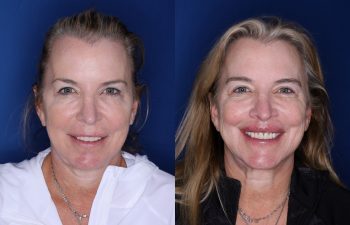 53 year old female 5 months post op from a modified subnasal lip lift